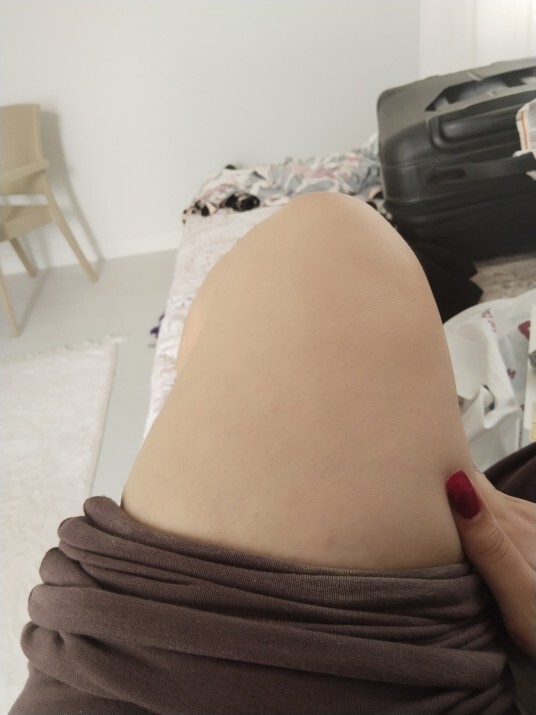 Bacak fondeteni öncesi sonrası?