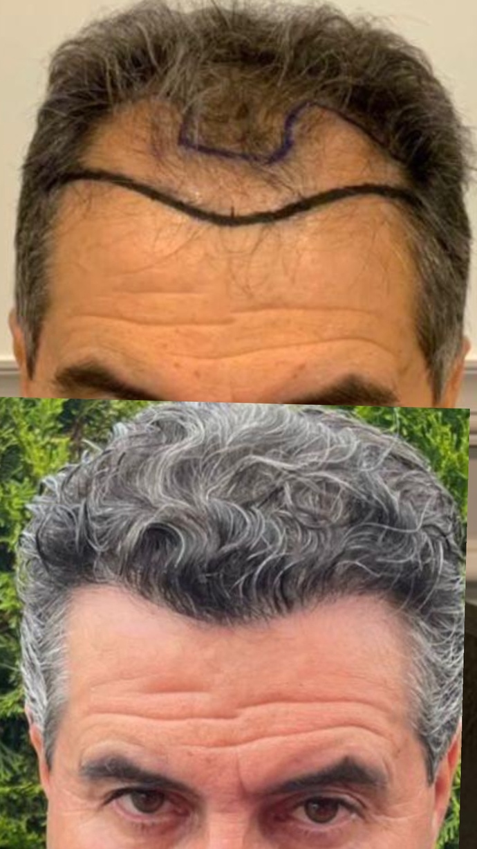 Saç ekimi yaptıracaklar dikkat! İyi bir araştırma nasıl yapılır? Hangi soruları sormalısınız? hangi cevaplar tatmin edici?