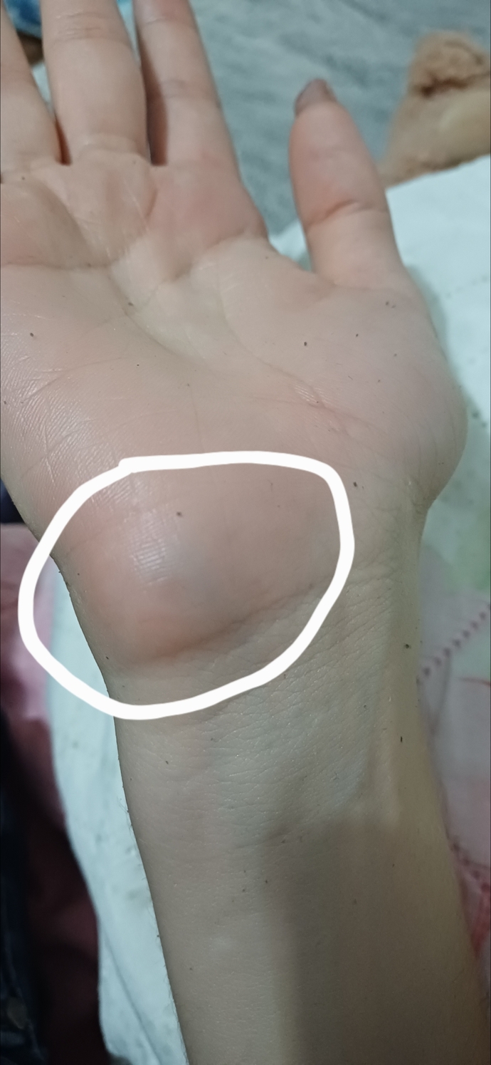 Sinirden elimi kapıya vurdum bi 10 kez felan sonra o kısım morardı hafif şişti bişi olmaz demi ezcaneden krem aldım sürüyorum?