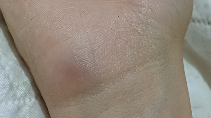 Sinirden elimi kapıya vurdum bi 10 kez felan sonra o kısım morardı hafif şişti bişi olmaz demi ezcaneden krem aldım sürüyorum?