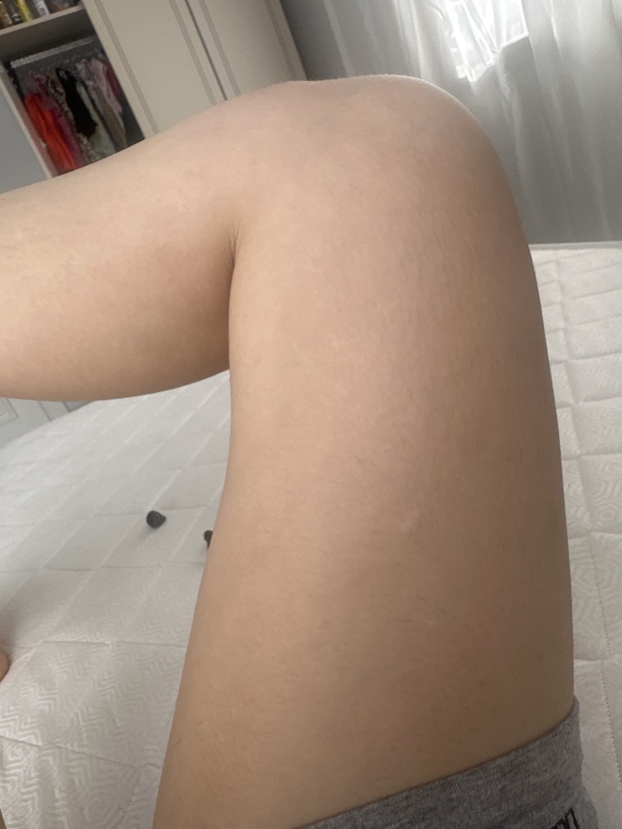 Bacağimda selülit yağlanma var mi sizce?