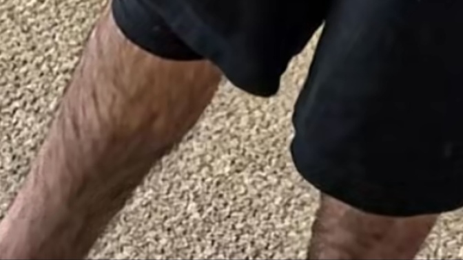 Bir erkeğin bacağında bu kadar kıl abartı mı yoksa normal mi?