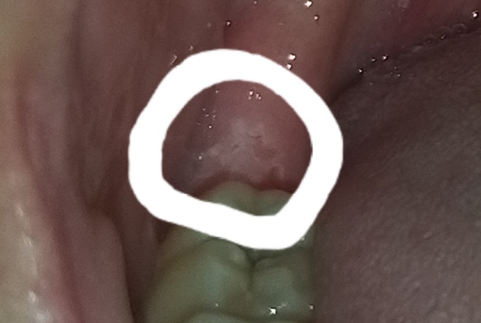 Foto bıraktım bakar mısınız ısaretledigim yerde böyle bir şey çıktı ve ağrı yapıyor 24 yaşındayım 20 lik diş böyle gelir mi?