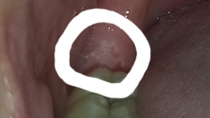 Foto bıraktım bakar mısınız ısaretledigim yerde böyle bir şey çıktı ve ağrı yapıyor 24 yaşındayım 20 lik diş böyle gelir mi?