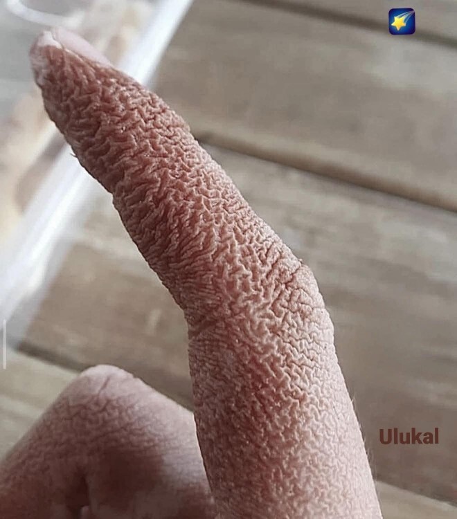 Parmaklarınız uzun süre suda kaldıktan sonra neden kırışır?