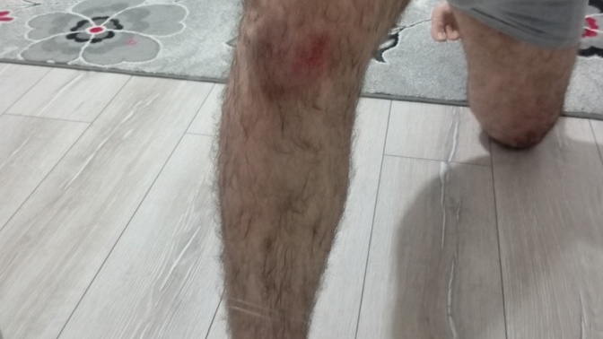 Dizim bu şekilde yandı, nasıl geçer?