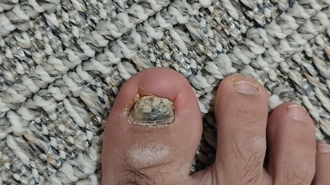Bu tırnak nasıl iyileşecek?