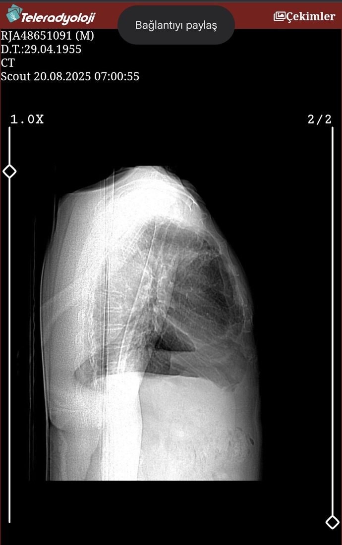 Akciğer tomografisi görüntüsü yorumlayabilen var mı?