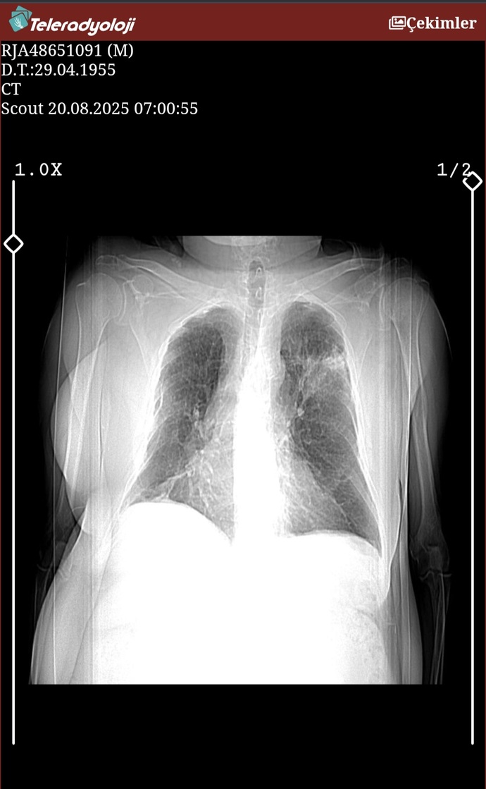 Akciğer tomografisi görüntüsü yorumlayabilen var mı?