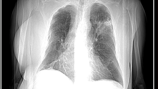 Akciğer tomografisi görüntüsü yorumlayabilen var mı?