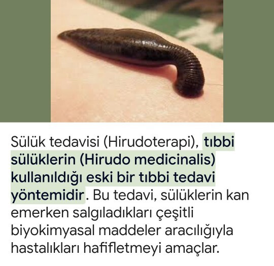 Aranızda sülük tedavisi yaptıran var mı?