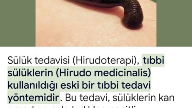 Aranızda sülük tedavisi yaptıran var mı?