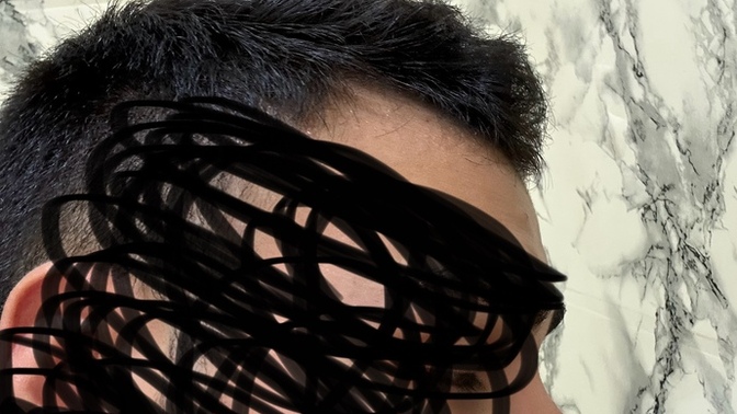 Sizce burnuma estetiğe gerek var mı tipim değişsin de istiyorum tamamen sizce kötü mü?