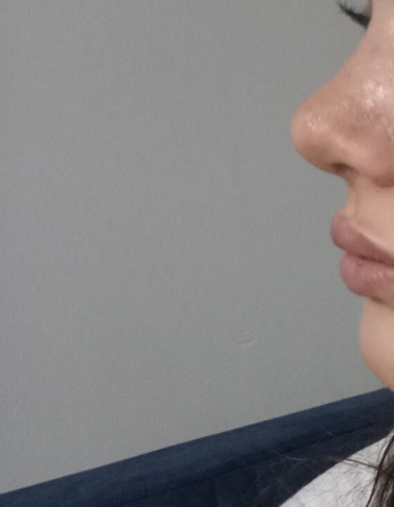 Burun ameliyati oldum ama istediğim gibi olmadı?