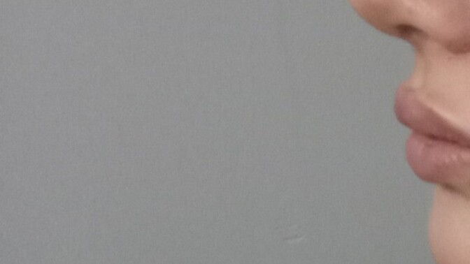 Burun ameliyati oldum ama istediğim gibi olmadı?