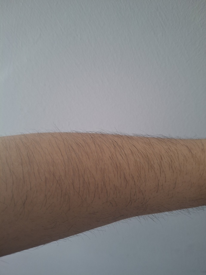 Bu kadar kıl çıkması normal mi lütfen linçlemeyin?