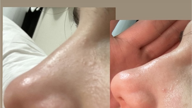 Burnum bir darbe sonucu sağdaki gibi oldu sizce ödem mi kemerleşmiş mi?