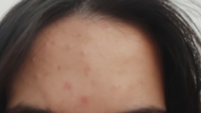 Sivilceleri kurutmak için ne yapmalıyım, çok mu kötü duruyor sivilceler?