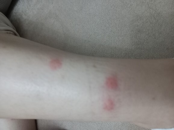 Ben bacağıma fondöten sürmüştüm sonra fondöteni silmeyi unuttum uyuya kalmışım sabah uyandığımda bacağım bu ṣekildeydi nasıl geçer?