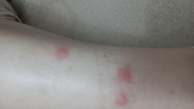 Ben bacağıma fondöten sürmüştüm sonra fondöteni silmeyi unuttum uyuya kalmışım sabah uyandığımda bacağım bu ṣekildeydi nasıl geçer?