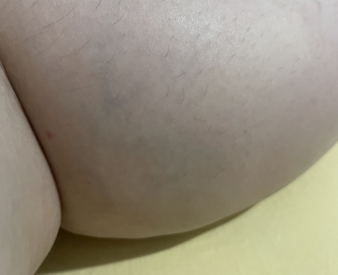 Dizimin arka kısmında böyle damarlar belirginleşmeye başladı bunun bi tedavisi varmıdır?