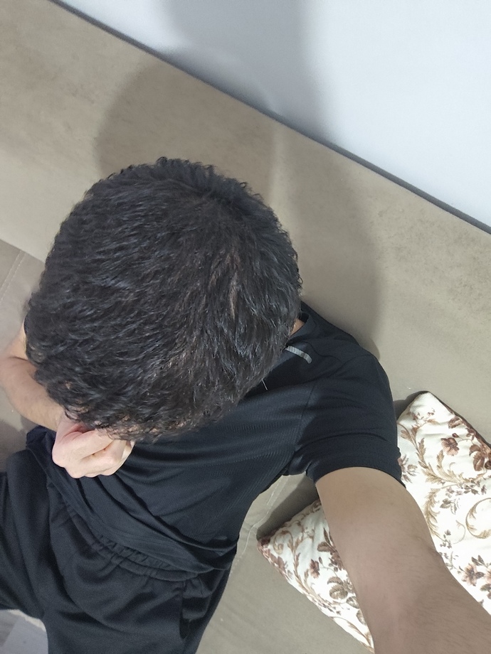 Saçım tek taraflı seyreliyor?