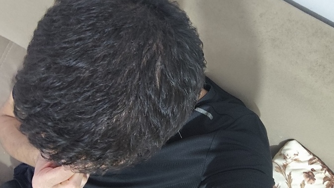 Saçım tek taraflı seyreliyor?