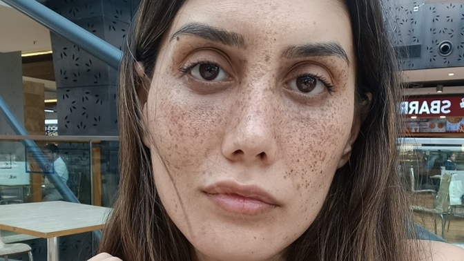 Tekrar burun estetiği olmalı mıyım burnum kötü duruyor mu sizce kusurlu olan yerleri yazarmisiniz?