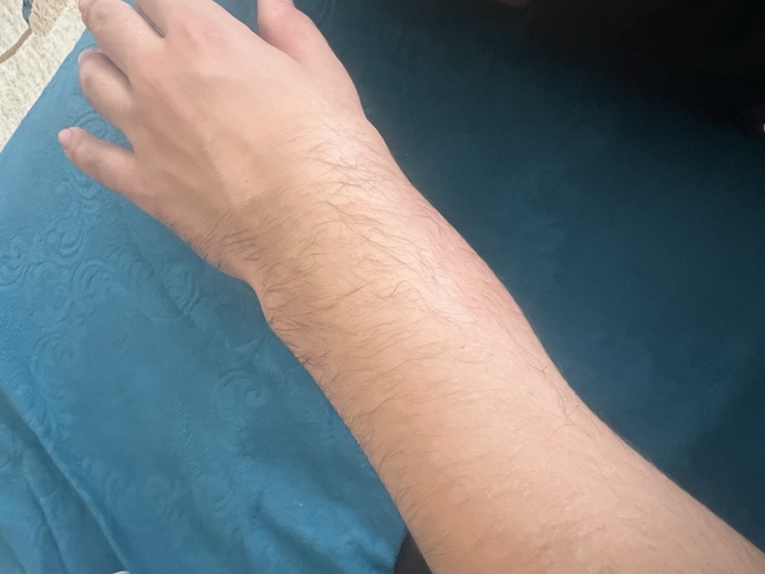 Acill halısahada kaleciydim elimde eldiven yoktu elim burkuldu çok şişti kırılmışmı bakar mısınız nasıl?