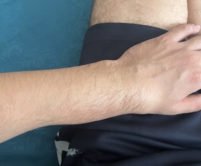 Acill halısahada kaleciydim elimde eldiven yoktu elim burkuldu çok şişti kırılmışmı bakar mısınız nasıl?