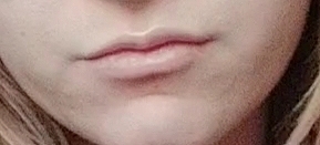 Dolgu yaptırmalı mıyım?