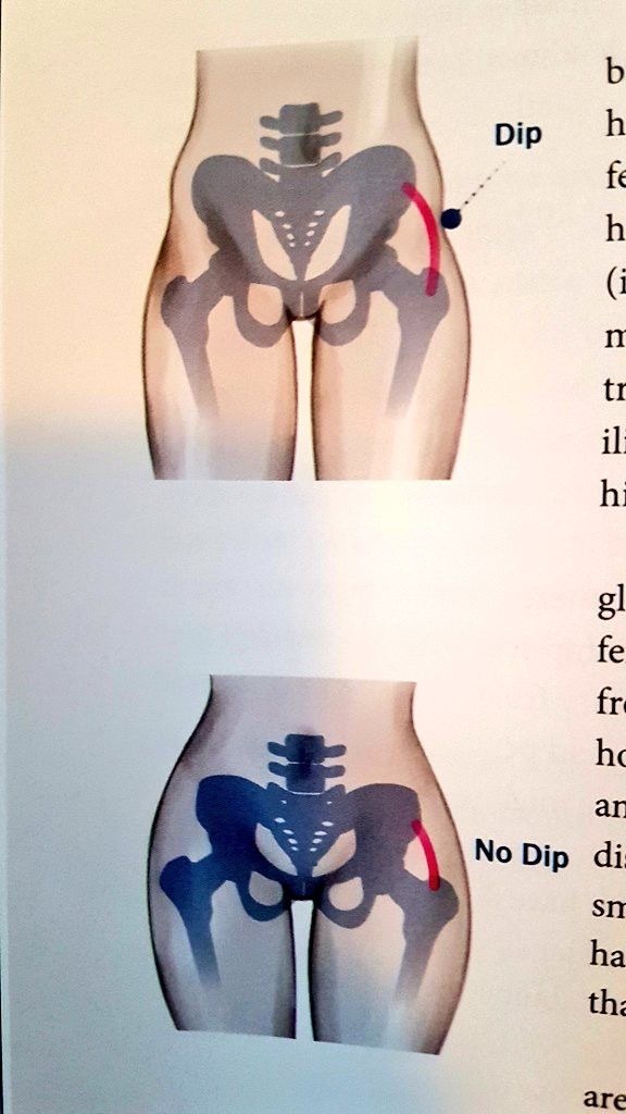 Hip dips problemi?