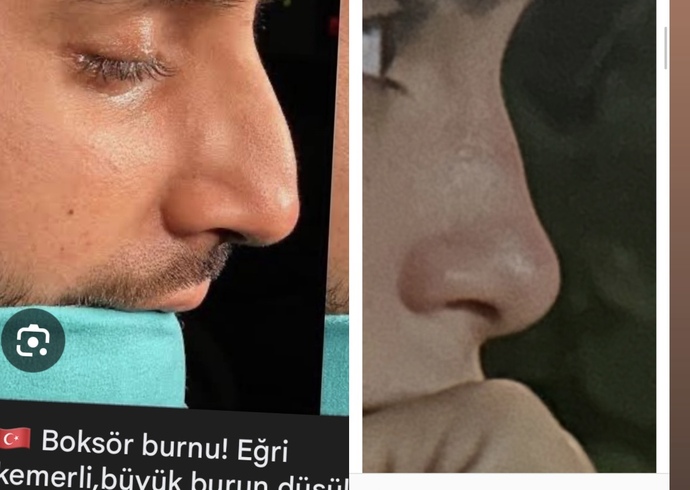 Siteden biri burnuma darbe aldıktan sonra burnun boksör burnu gibi olmuş dedi öyle mi?