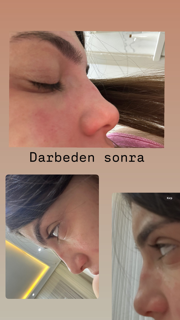 Estetik cerrahları 6 aydan önce müdehale edemezmiş bu doğru mu?