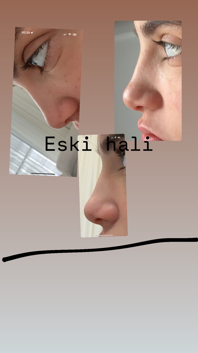 Estetik cerrahları 6 aydan önce müdehale edemezmiş bu doğru mu?