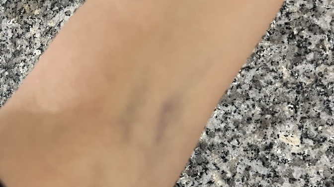 Sağlık raporu için hastane kan aldı kolum 1 haftadan fazladır mor ya neden böyle suratları da beş karış zaten?
