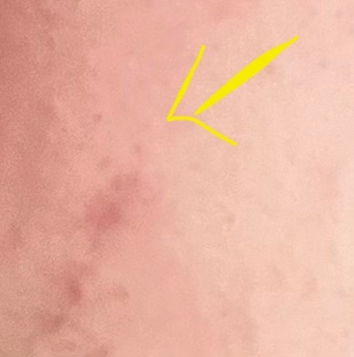 Yüzdeki kılcak damar patlayınca lekesi kalıcı mı?