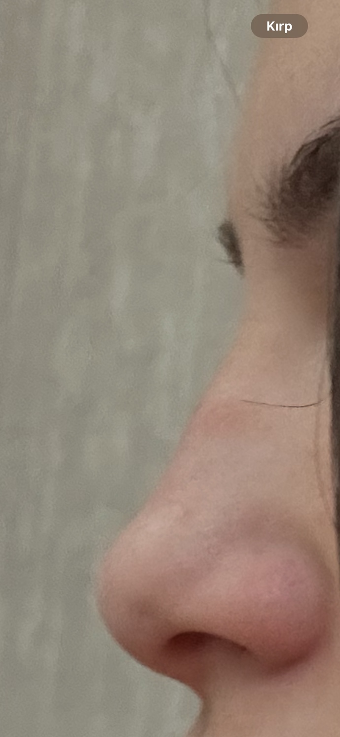 Burnumdaki çıkıntı daha önceye göre inmiş mi ayni mi?