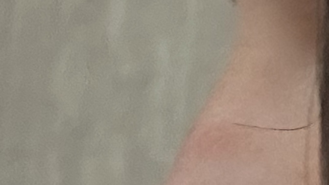 Burnumdaki çıkıntı daha önceye göre inmiş mi ayni mi?