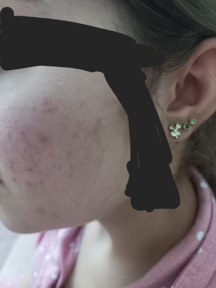 Yüzümdeki bu sivilce ve sivilce izleri nasıl geçer?