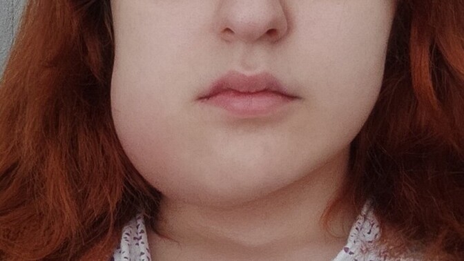 20 lik diş çekimi yanak şişliği normal mi?