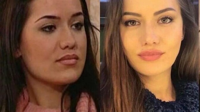 Estetik güzelleştirir mi?