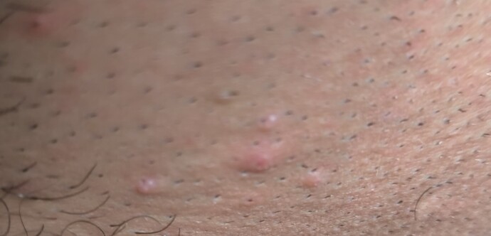 Kasik bölgemde boyle bi sey var hpv siğili mi?