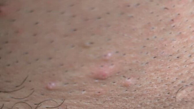 Kasik bölgemde boyle bi sey var hpv siğili mi?