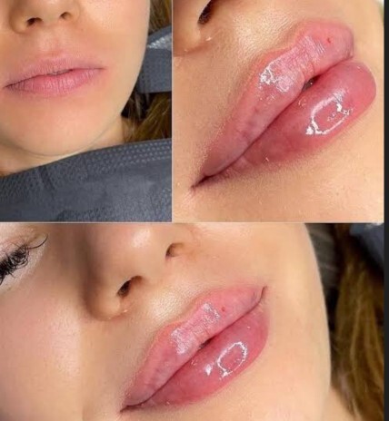 Kadınlara dolgu dudak yakışıyor mu?