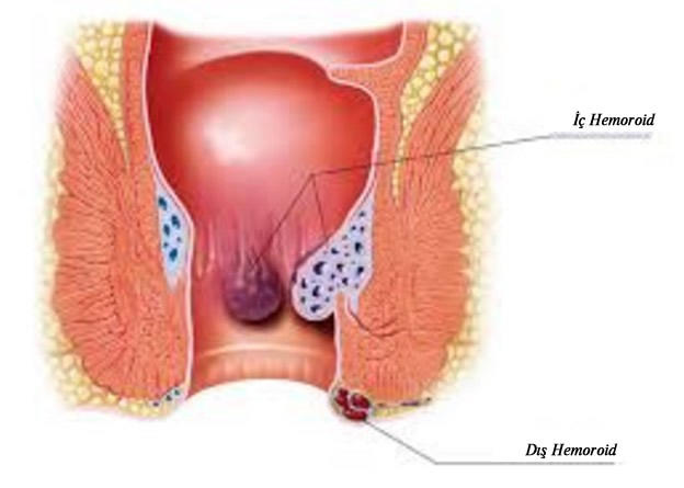 Hemoroid (Basur) için hangi doktora gitmeliyim?