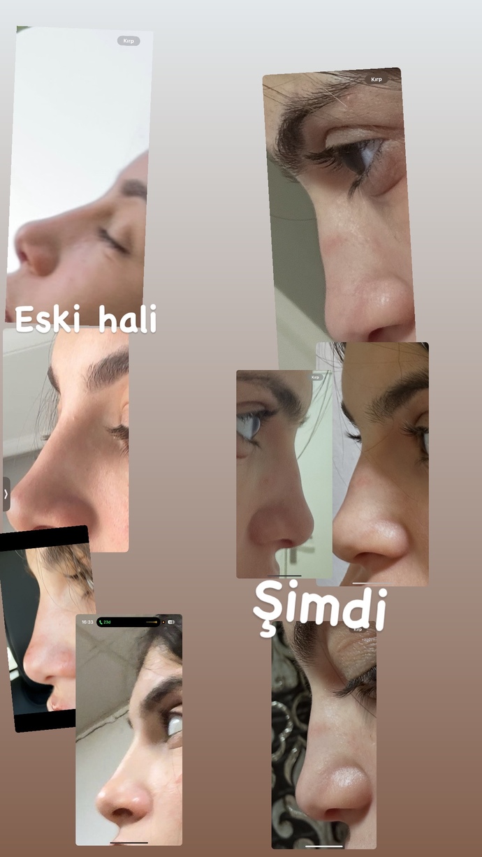 Burnumu ameliyatla eski haline çevirebilirler mi bozarlar mi?