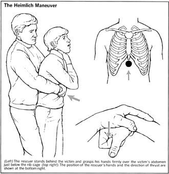 Heimlich manevrası yapmasını biliyor musunuz?