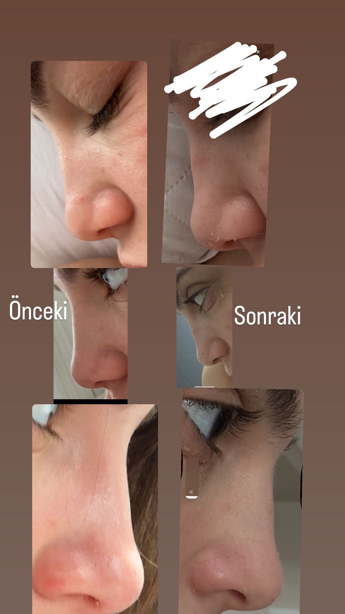 Burnum eskiye göre kemerleşmiş mi çok?