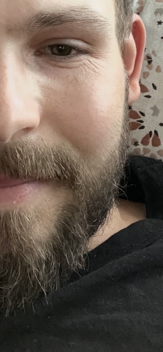Gülünce oluşan kırışların çaresi nedir?